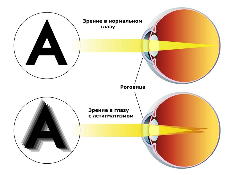 Зрение в нормальном глазу и в глазу с астигматизмом
